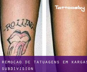 Remoção de tatuagens em Kargas Subdivision