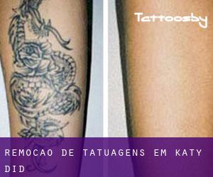 Remoção de tatuagens em Katy Did