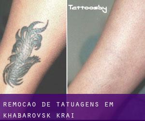 Remoção de tatuagens em Khabarovsk Krai