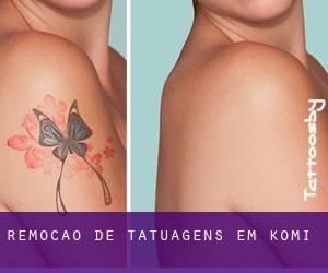 Remoção de tatuagens em Komi