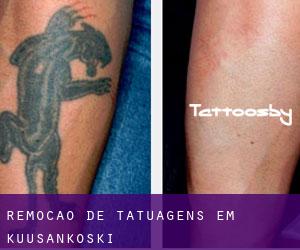 Remoção de tatuagens em Kuusankoski