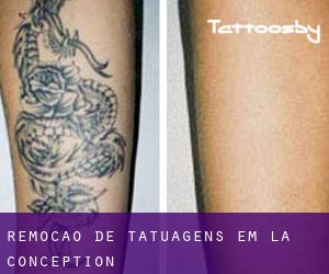 Remoção de tatuagens em La Conception