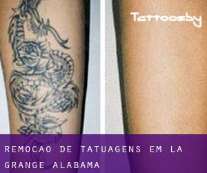 Remoção de tatuagens em La Grange (Alabama)