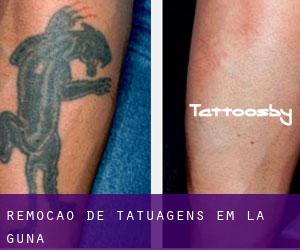 Remoção de tatuagens em La Guna