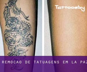 Remoção de tatuagens em La Paz