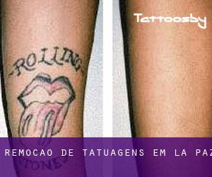 Remoção de tatuagens em La Paz