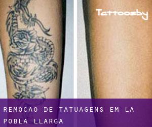 Remoção de tatuagens em La Pobla Llarga