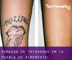 Remoção de tatuagens em La Puebla de Almoradiel