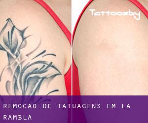 Remoção de tatuagens em La Rambla