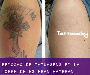 Remoção de tatuagens em La Torre de Esteban Hambrán