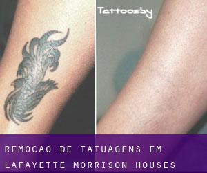 Remoção de tatuagens em Lafayette Morrison Houses