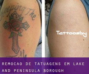 Remoção de tatuagens em Lake and Peninsula Borough
