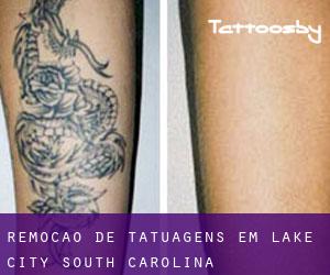 Remoção de tatuagens em Lake City (South Carolina)