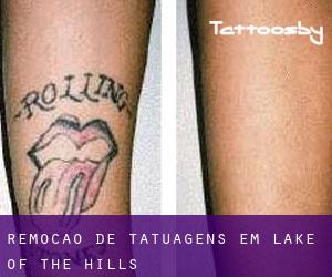 Remoção de tatuagens em Lake of the Hills