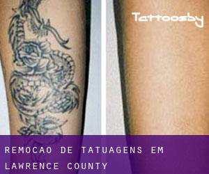 Remoção de tatuagens em Lawrence County