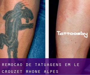 Remoção de tatuagens em Le Crouzet (Rhône-Alpes)