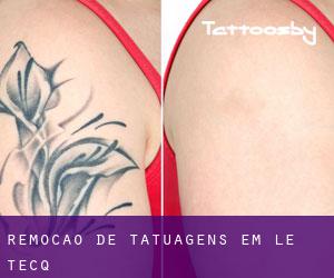 Remoção de tatuagens em Le Tecq