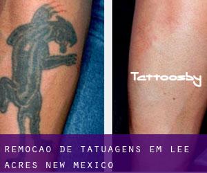 Remoção de tatuagens em Lee Acres (New Mexico)
