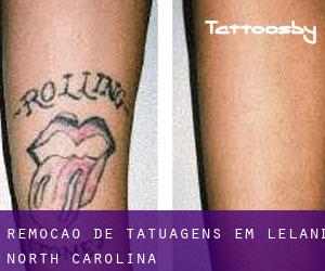 Remoção de tatuagens em Leland (North Carolina)