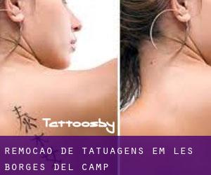 Remoção de tatuagens em les Borges del Camp