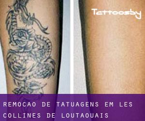 Remoção de tatuagens em Les Collines-de-l'Outaouais