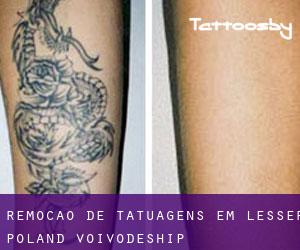 Remoção de tatuagens em Lesser Poland Voivodeship