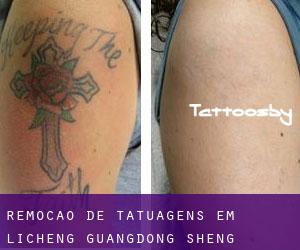 Remoção de tatuagens em Licheng (Guangdong Sheng)