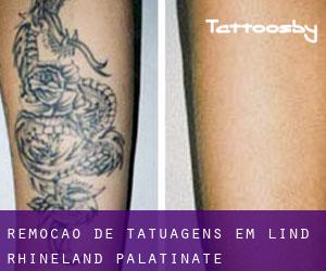 Remoção de tatuagens em Lind (Rhineland-Palatinate)