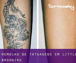 Remoção de tatuagens em Little Browning