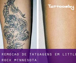 Remoção de tatuagens em Little Rock (Minnesota)
