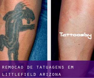 Remoção de tatuagens em Littlefield (Arizona)