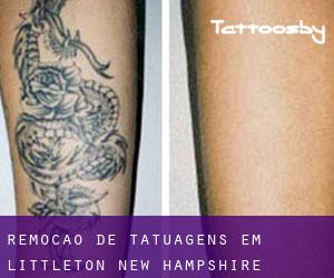 Remoção de tatuagens em Littleton (New Hampshire)