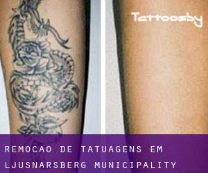 Remoção de tatuagens em Ljusnarsberg Municipality