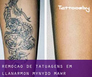 Remoção de tatuagens em Llanarmon-Mynydd-mawr