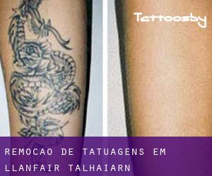 Remoção de tatuagens em Llanfair Talhaiarn