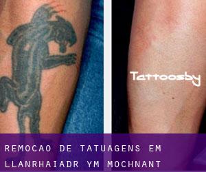 Remoção de tatuagens em Llanrhaiadr-ym-Mochnant