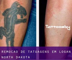 Remoção de tatuagens em Logan (North Dakota)