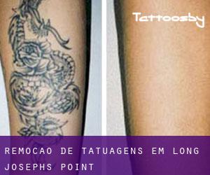 Remoção de tatuagens em Long Josephs Point