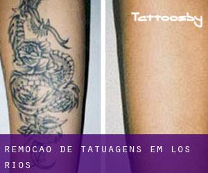 Remoção de tatuagens em Los Ríos