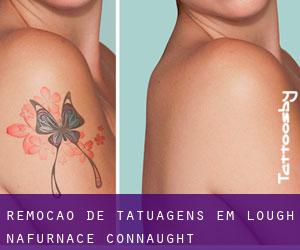 Remoção de tatuagens em Lough Nafurnace (Connaught)