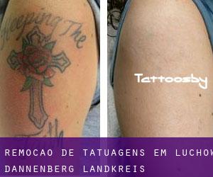 Remoção de tatuagens em Lüchow-Dannenberg Landkreis