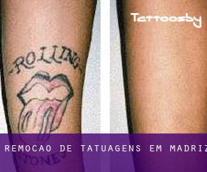 Remoção de tatuagens em Madriz