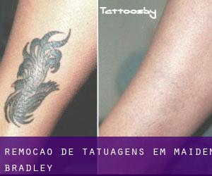 Remoção de tatuagens em Maiden Bradley