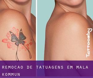 Remoção de tatuagens em Malå Kommun