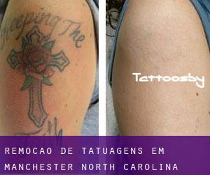 Remoção de tatuagens em Manchester (North Carolina)