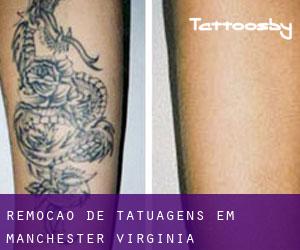 Remoção de tatuagens em Manchester (Virginia)