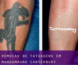 Remoção de tatuagens em Mangamaunu (Canterbury)