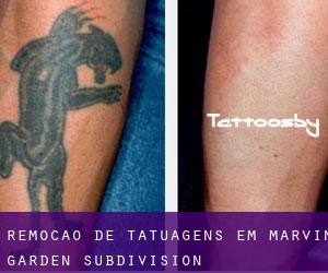 Remoção de tatuagens em Marvin Garden Subdivision