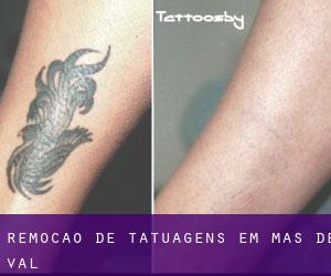 Remoção de tatuagens em Mas-de-Val