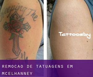 Remoção de tatuagens em McElhanney